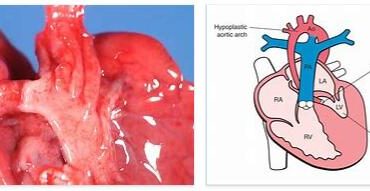 Aortic arch syndrome